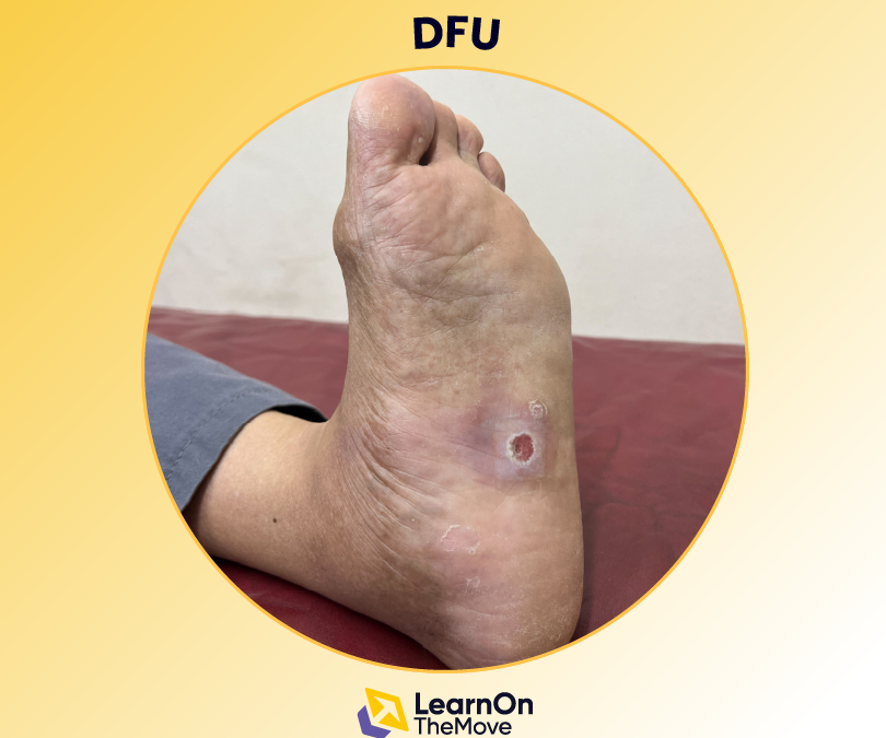 Diabetic foot ulcers (DFU)