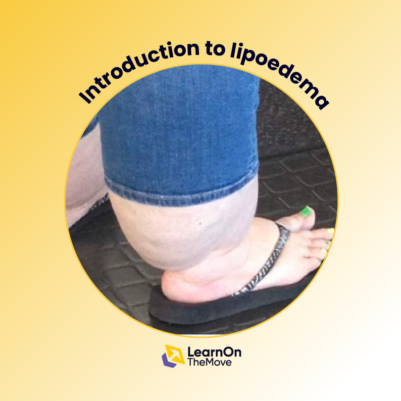 Understanding Lipoedema